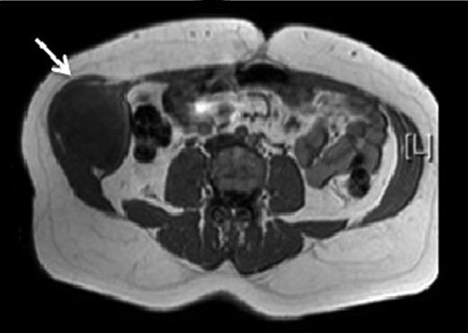 T1 MRI showing a soft tissue abdominal wall tumour involving external oblique, internal oblique and transversus abdominis and not involving the peritoneum (arrow).