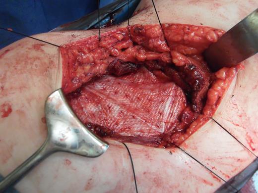 Depicting the porcine intestinal biological mesh in place after tumour excision.