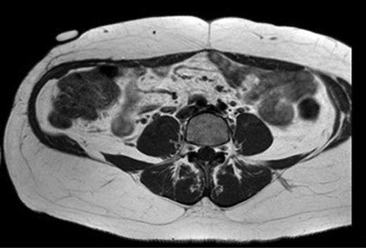 Twelve-month postoperative MRI.