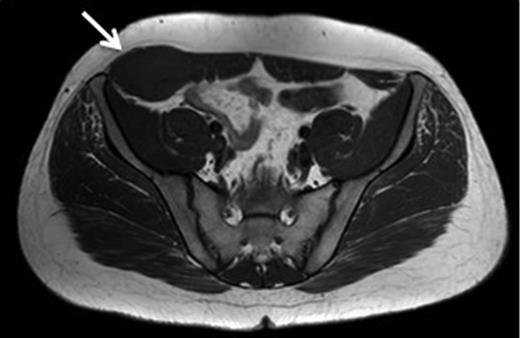 T1 MRI showing a soft tissue tumour of the anterior abdominal wall involving external oblique and internal oblique and not involving the peritoneum.