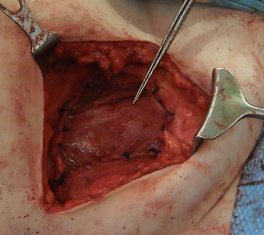 Depicting the use of porcine intestinal biological mesh to repair an anterior abdominal wall defect left by aggressive fibromatosis.