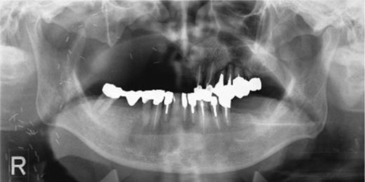 Preoperative orthopantomography. Molar teeth on the left side had been previously extracted because of severe periodontitis.