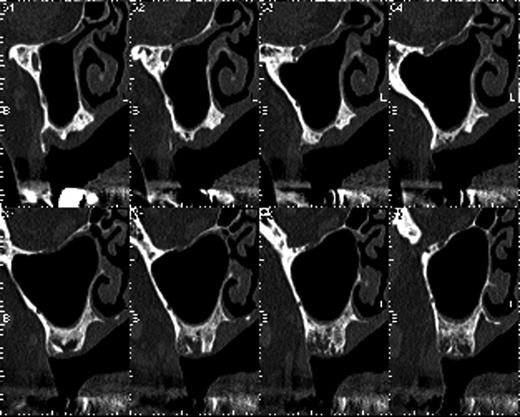 The bone mass in the left molar region was inadequate for implantation of fixtures.