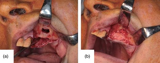(a) The sinus cavity. A 12 × 5 mm section of bone has been removed at the maxillary sinus anterior wall with a piezoelectric instrument. There is no apparent damage of the membrane of the maxillary sinus. (b) Artificial bone has been grafted in the formed sinus cavity and placed on the alveolar bone.