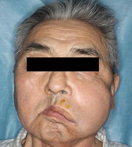 After sinus-lift surgery, marked swelling is obvious from the left buccal region to the angulus oculi medialis.