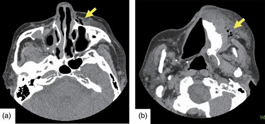 (a and b) Postoperative CT. Emphysema (indicated by arrows) is visible from the left buccal region to the angulus oculi medialis.