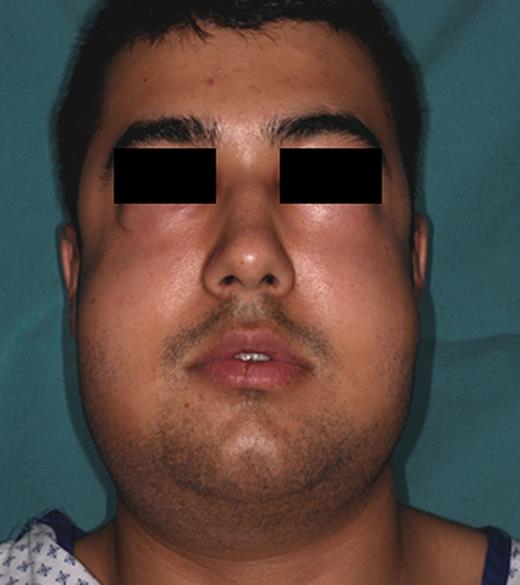 Clinical appearance of the patient with distinct swelling in the periorbital, cheek and supraclavicular region after bilateral wisdom tooth removal.