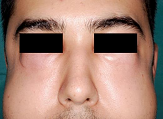 The patient had difficulty to open his eyes.