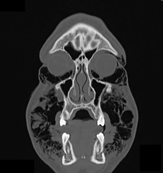 CT scan (coronal section in the first premolar region) showing multiple air inclusions within the facial soft tissue.