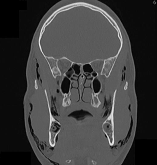The frontal CT scan of the head and neck region (section in the retromolar region) illustrates bilaterally trapped air into the soft tissue reaching from the temporal fascia through to the supraclavicular region.