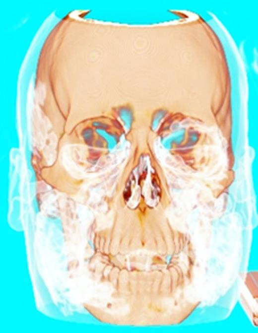 Three-dimensional reconstruction of the CT scan showing the trapped air in the head and neck region.