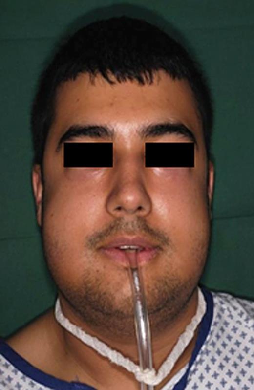 The patient after 3 days with tube in place, which served as a valve to avoid air pressure within the oral cavity.