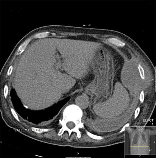 CT image demonstrating a well-defined chest-wall lesion encasing ribs, without rib destruction.