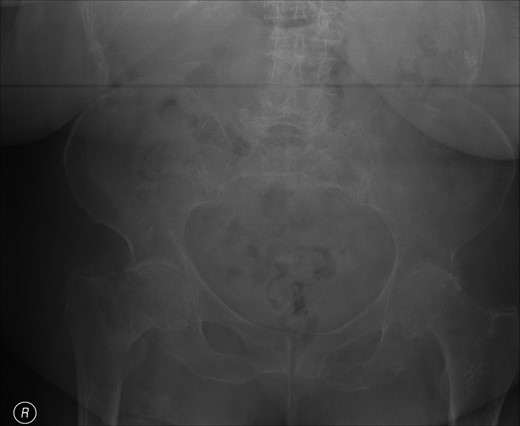 Anteroposterior (AP) film of right hip at presentation.