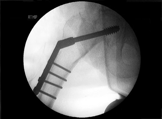 Intraoperative AP view of right hip.