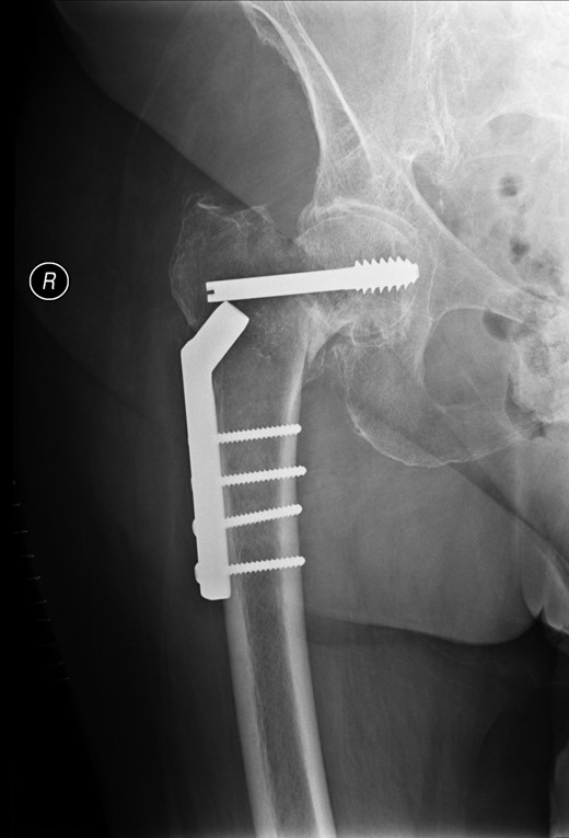 AP view of right hip at 2 weeks after surgery.