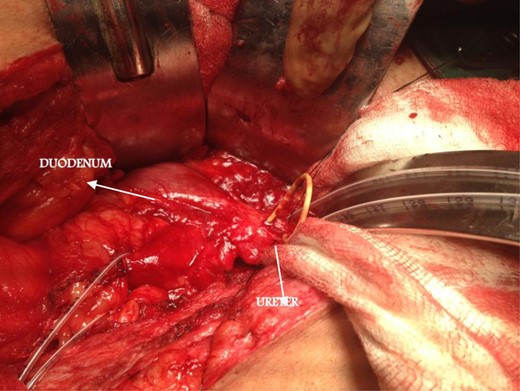 Intraoperative finding.