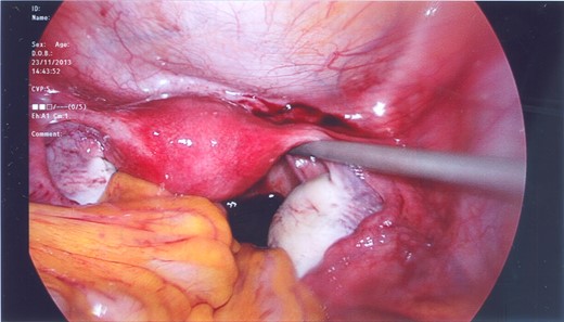 Laparoscopic capture showing 30 ml free blood in the Douglas pouch.
