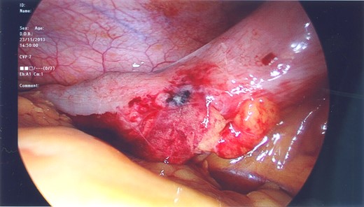 Laparoscopic capture showing the contusion and ischaemic appearance of the descending colon.