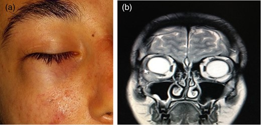 (a) A 19-year-old female patient with an immobile mass in the right inferior temporal location. (b) The MRI results of the patient show a mass fixed to the inferior orbital wall.