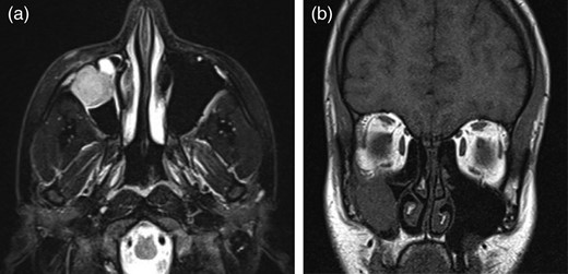 (a and b) The emergency MRI results of the patient who had complaints of infraorbital anesthesia in the postoperative week 3 revealed a mass invading the right maxillary sinus and probably compressing on the infraorbital nerve.