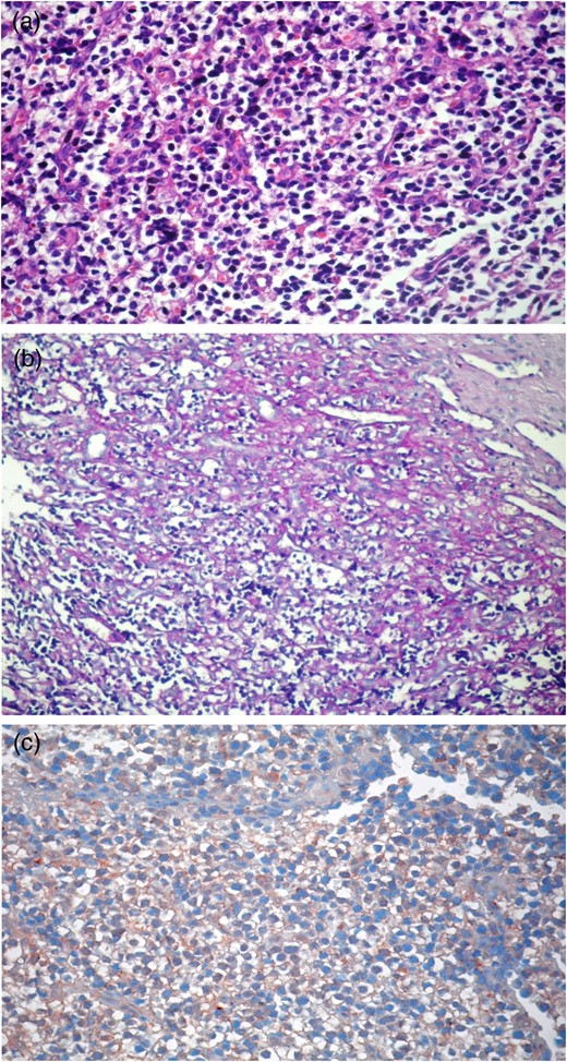 (a–c) Round-shaped, narrow eosinophilic cytoplasm cells with hyperchromatic nuclei (b: PAS+ and c: CD99+).