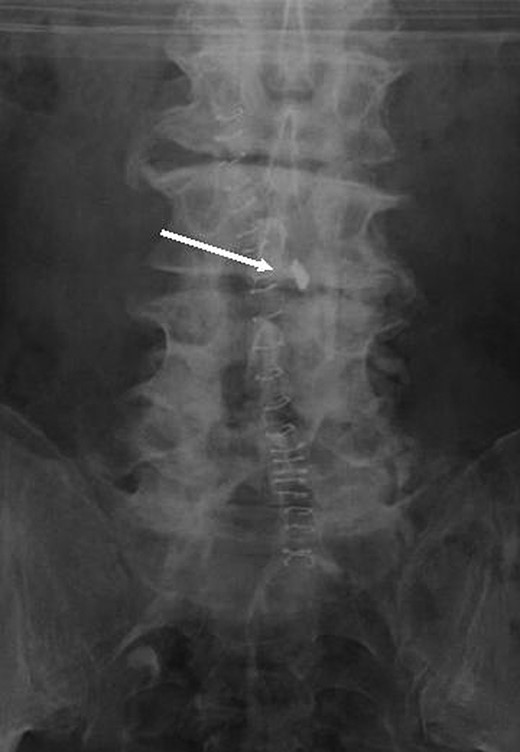 Postoperative plain Anterior-Posterior film.