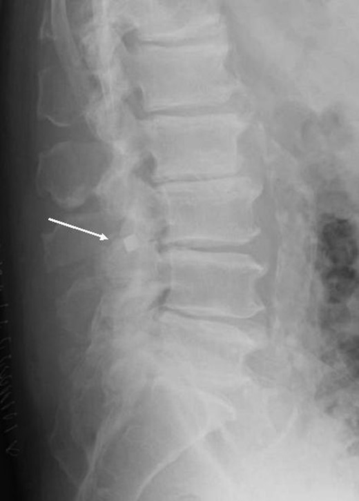 Postoperative plain lateral film.