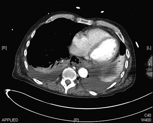 CT chest showing mediastinitis, bilateral pleural effusions and free air around the distal oesophagus.
