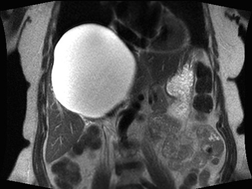 Coronal MRI view of the giant hepatic cyst.