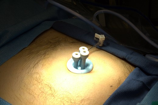 Single-incision laparoscopic port inserted through the umbilicus.