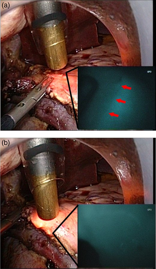 (a) The head of the pancreas has been resected laparoscopically. The pancreatic resection margin appears healthy to the naked eye with a small (<3 mm) pancreatic duct. ICG has been injected intravenously into the patient. The infrared camera is then switched on, and the ischaemic segment of the pancreatic margin demonstrating no ICG fluorescence can be visualized. (b) After resection of the ischaemic portion, the margin appears well perfused.