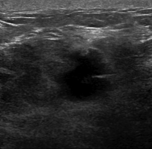 Left breast ultrasound. There is a 1.9 × 1.4 cm irregular mass in the left breast at 11–12:00 6 cm from the nipple.