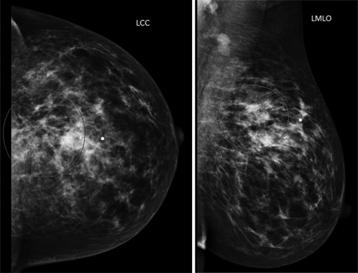 Left mammogram. The circled area revealed a 2-cm irregular mass with biopsy clip noted.