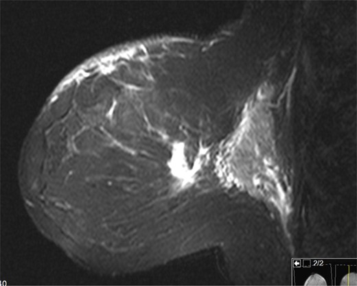 Left breast on MRI. There was a 2.2 cm enhancing mass in the left breast at 12:00 that was consistent with the patient's biopsy-proven malignancy.