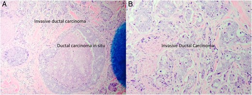 Low power view of the left breast core biopsy (A). High power view of the left breast core biopsy (B).