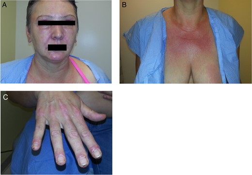 Image of patient with facial rash and periorbital edema that initially developed during her workup (A). Images of the worsening rash on her chest and hands that initially developed during her workup (B and C).