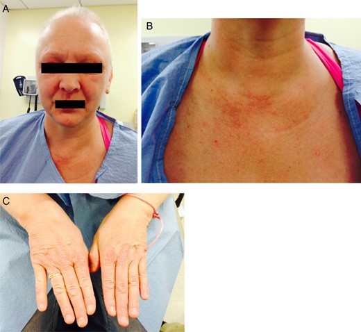 Images of patient at her 6-month follow-up visit. Note complete resolution of facial rash and periorbital edema and rash on her hand. There is almost complete resolution of the rash on her chest.