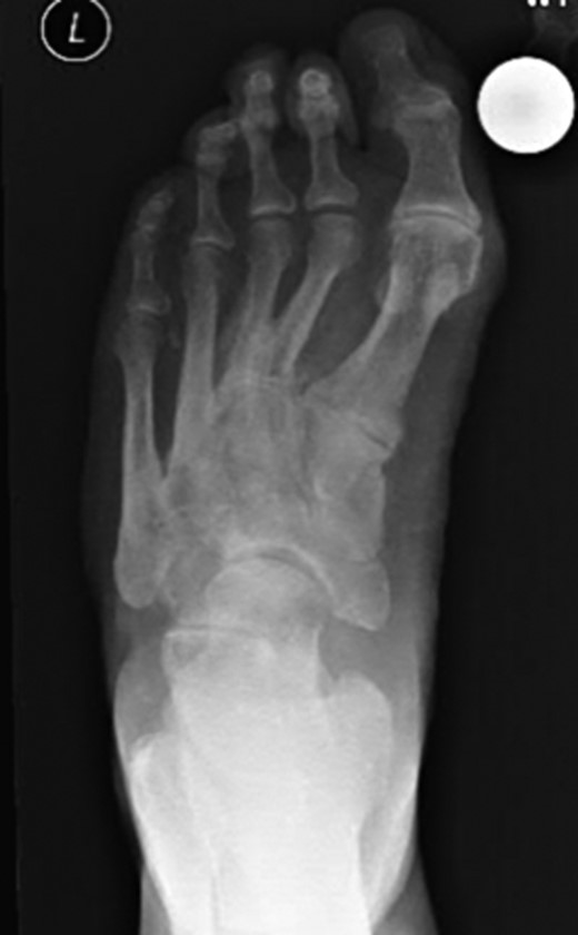 Dorsoplanter radiograph of the left foot with the clearly visible additional middle cuneiform.