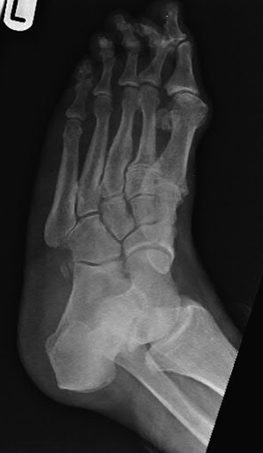 Oblique radiograph of the left foot with the clearly visible additional middle cuneiform.