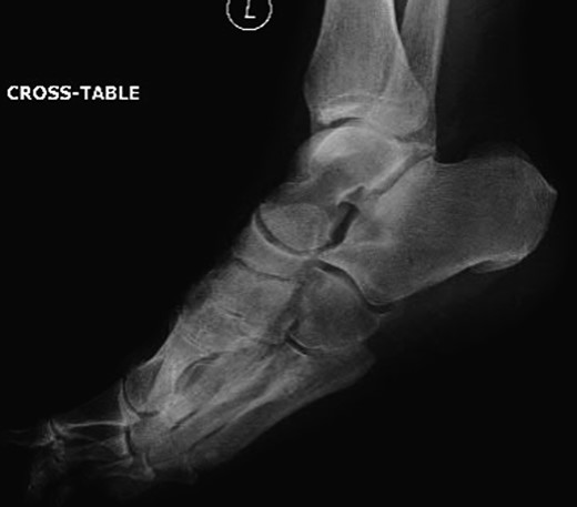 Lateral radiograph of the left foot with the clearly visible additional middle cuneiform.