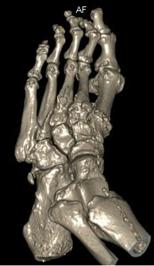 Three-dimensional CT reconstruction of the left foot in the dorsoplanter orientation.