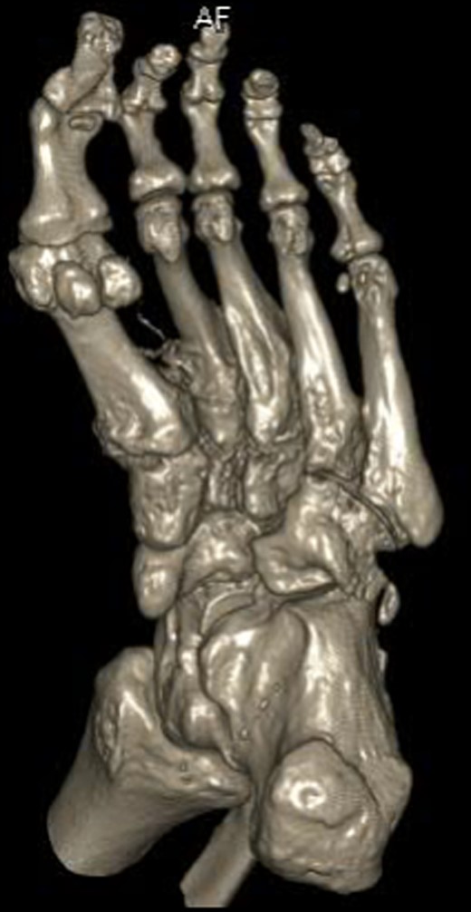 Three-dimensional CT reconstruction of the left foot in the planterdorsal orientation.