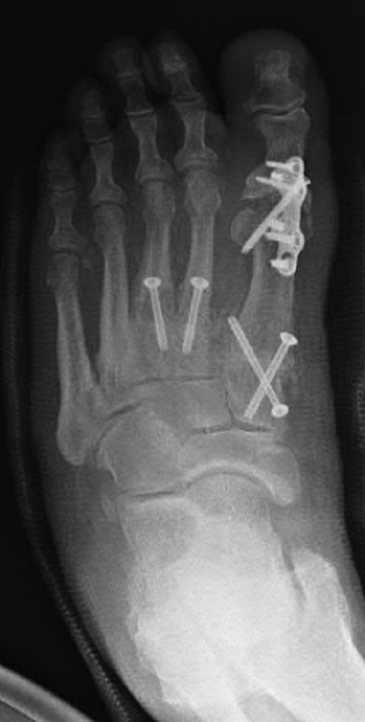 Oblique radiograph of the left foot following first MTPJ and first, second and third TMTJ fusions.
