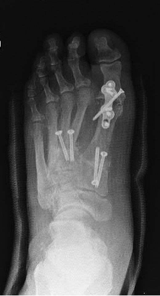 Dorsoplanter radiograph of the left foot following first MTPJ and first, second and third TMTJ fusions.