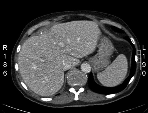 CT showing the spilled stones.