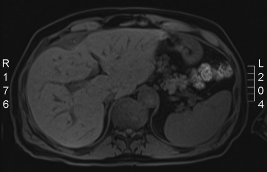 MRI showing the spilled stones.