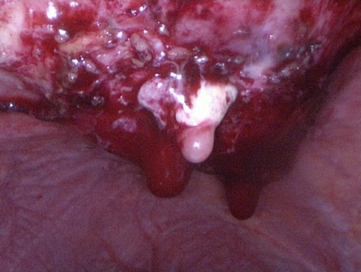 Laparoscopic view of the chronic abscess.