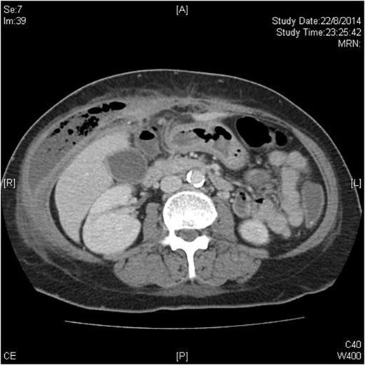 Transverse plane of CT scan showing right-sided abdominal wall collection with fish bone just visible as a hyperdense dot just anterior to the liver.