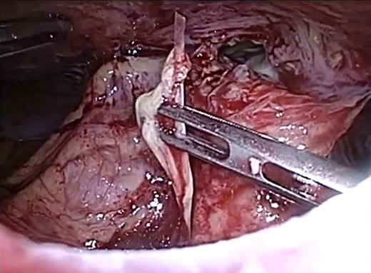 Laparoscopic view of the abdominal wall abscess and retrieved fish bone.